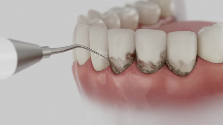 Trusted Wisdom Tooth Removal service in Hurst, TX - Dentist Open Now